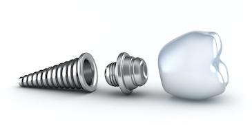 wilmington de dental implants
