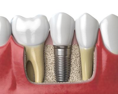 Close up image of a dental implant, wilmington de
