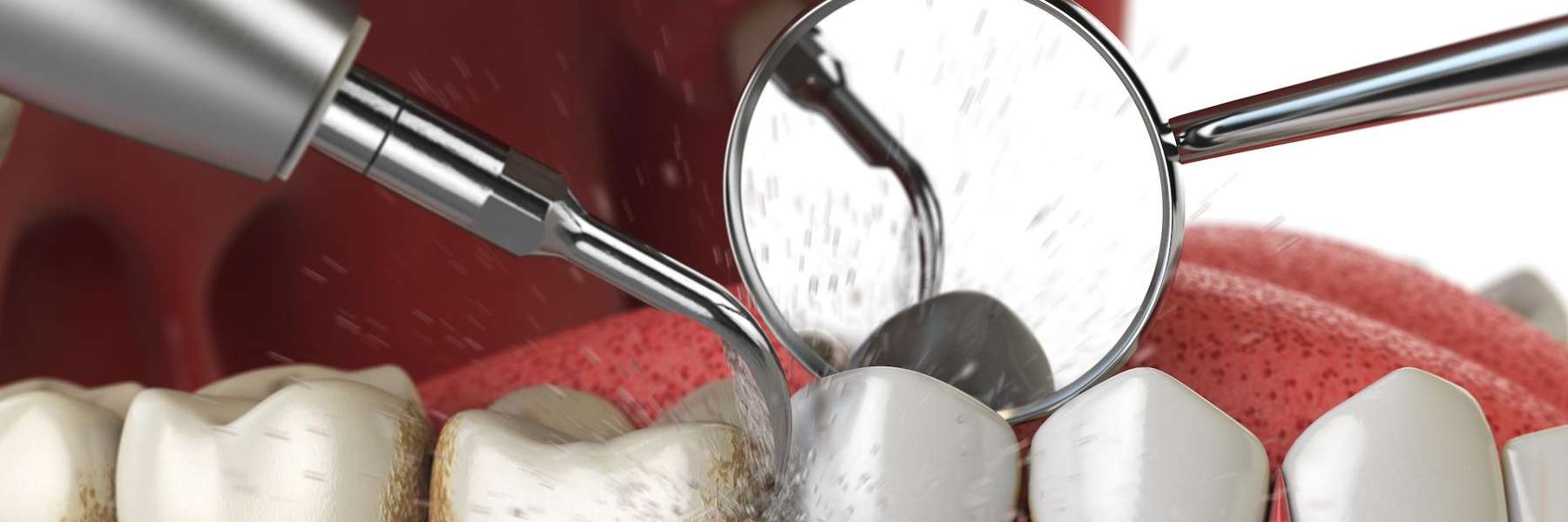 Image of teeth being cleaned, wilmington de