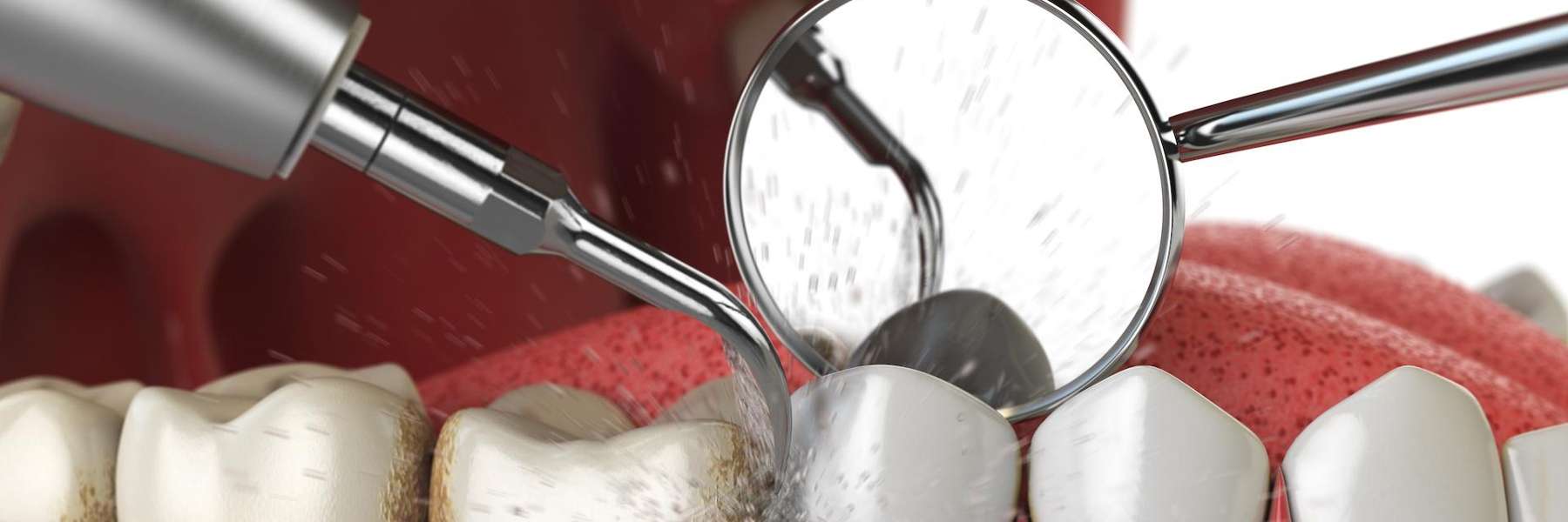teeth cleaning wilmington de