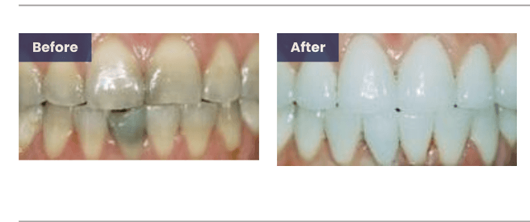 before and after images for teeth whitening in wilmington de