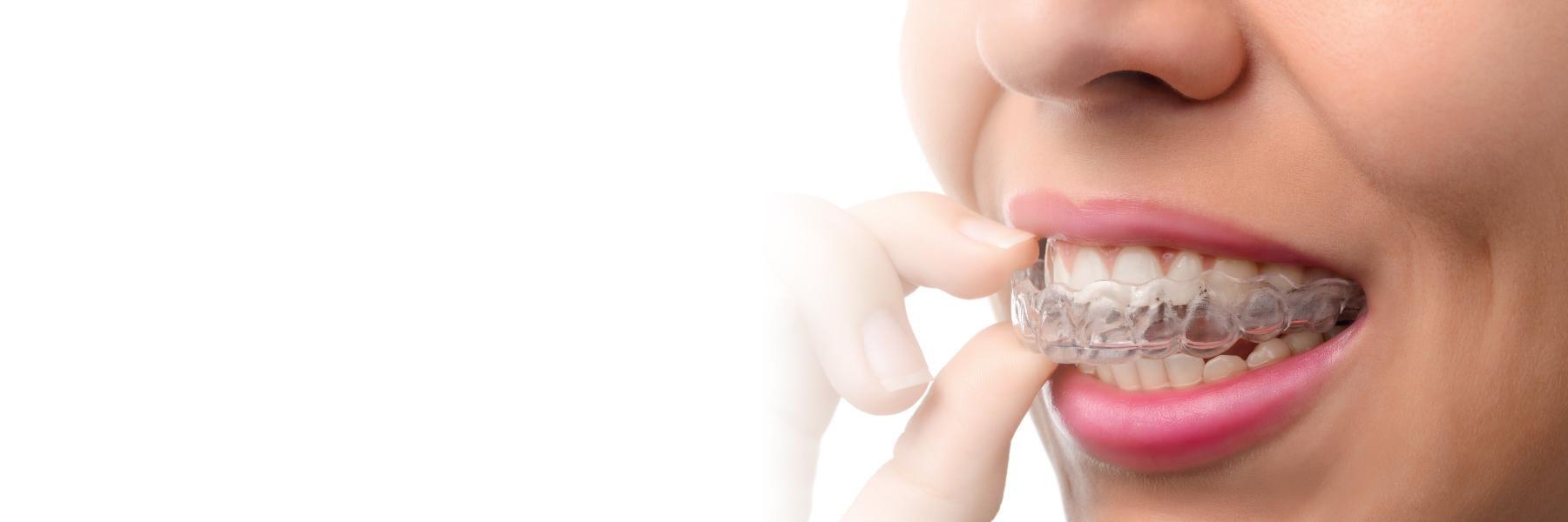 Woman putting on Invisalign clear aligners in Wilmington DE