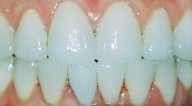Results from smile makeover at cosmetic dentist in Wilmington DE