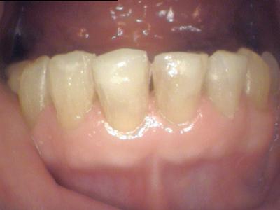 Results from tooth colored fillings procedure in Wilmington DE