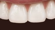 Results from Six Month Smiles teeth alignment in Wilmington DE