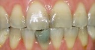 Close up of dental patients decayed and discolored teeth at 19810 dentist