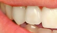 Close up of yellow teeth before professional teeth whitening in Wilmington DE