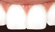 Close up of restored front tooth with porcelain veneers in 19810