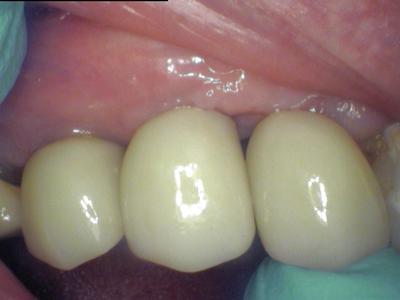 Close up of patient with dental crowns and implants in Wilmington DE