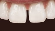 Close up of dental patient with gap in front teeth before Six Month Smiles in 19810