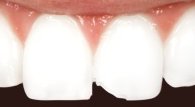 Close up of chipped front tooth at emergency dentist in Wilmington DE