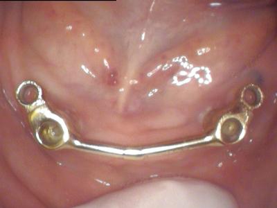 Close up of dental patients mouth with implant supported dentures in Wilmington DE