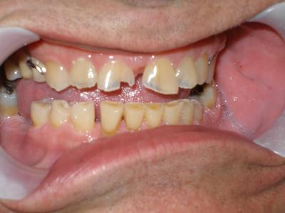 Close up of patients with chipped teeth and decay at 19810 dentist office