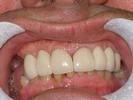 Results from dental crowns procedure in Wilmington DE