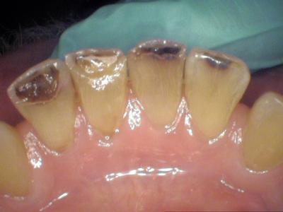 Close up of bottom teeth with tooth decay on the backside at 19810 dentist