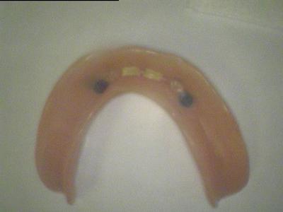 Back side of implant supported dentures in 19810