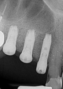 Digital x-ray of dental implants in Wilmington DE