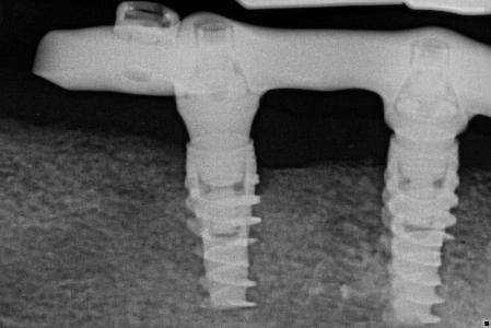 Digital scan of implant supported dentures in Wilmington DE