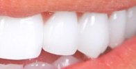 Results from teeth whitening at cosmetic dentist in Wilmington DE