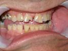 Close up of patients with chipped teeth and decay at 19810 dentist office